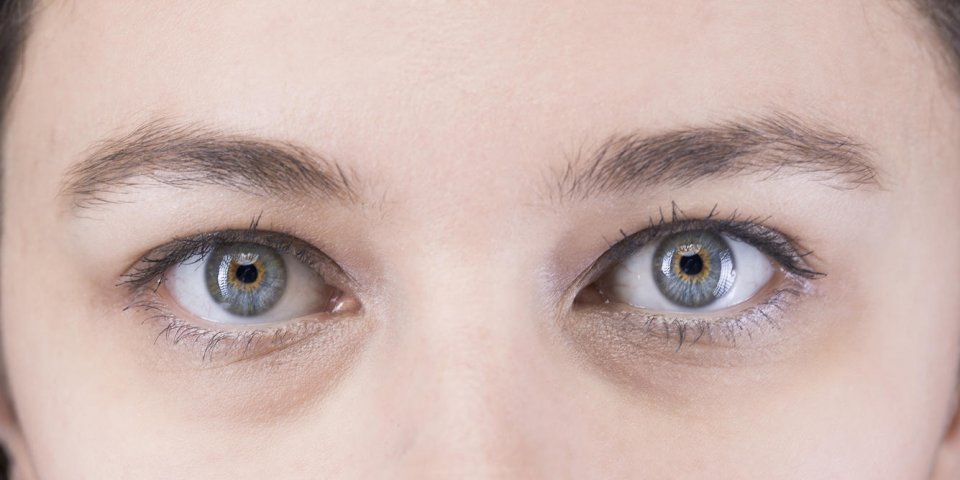 Point blanc sur l'œil : un signe de kératite